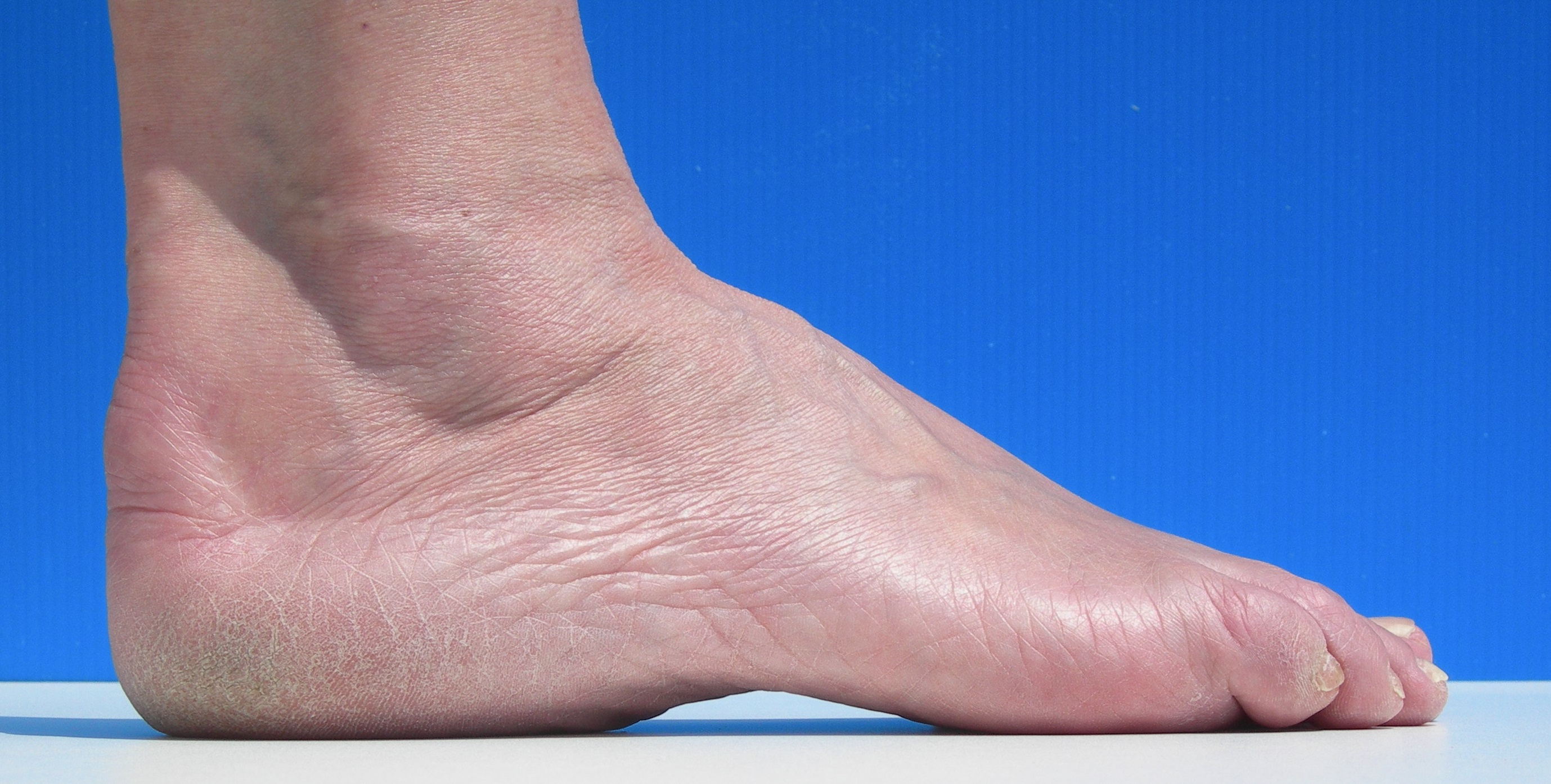 Pathologies Pieds creux